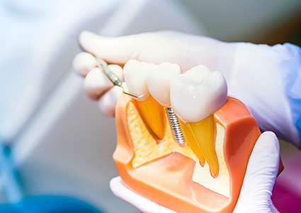 Zukunftzahn Zahnheilkunde Zahnimplantat
